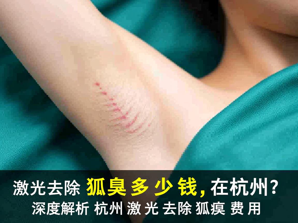 激光去除狐臭多少钱在杭州？深度解析杭州激光去除狐臭费用